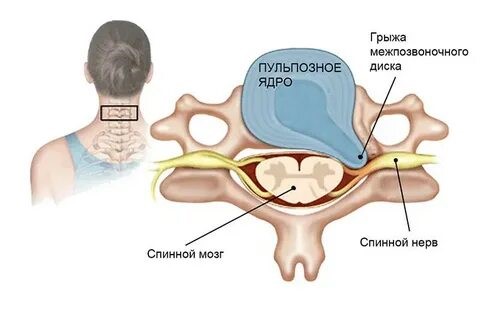 Опухоль спинного мозга